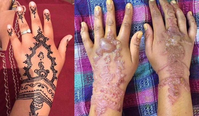 Opgelet met henna tattoos!