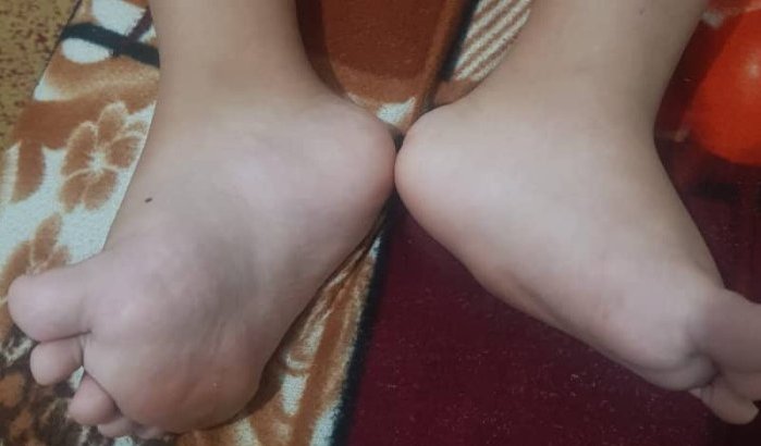 Bilal (12) uit Tetouan heeft dringend hulp nodig