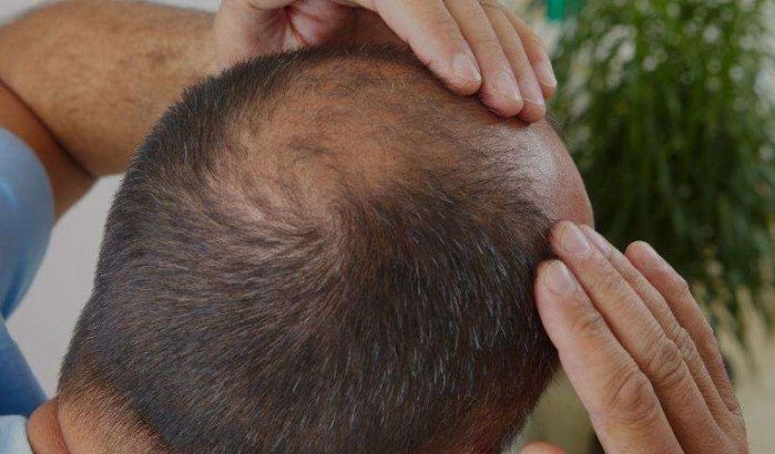 Marokkanen kiezen Turkije voor haartransplantatie