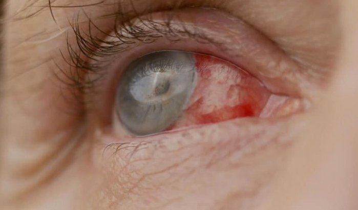 Rabat: patiënt blind na operatie door nepdokters