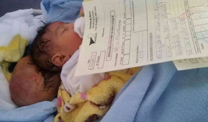Marokko: baby met twee hoofdjes met succes geopereerd dankzij weldoener