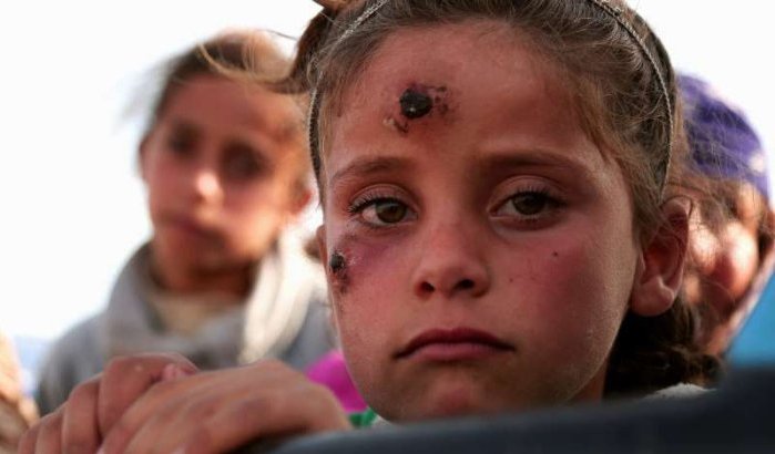 Leishmaniase epidemie in Zagora, 150 kinderen getroffen (video)