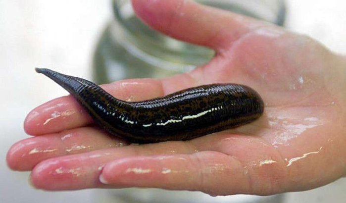Meisje in Marokko leefde met bloedzuiger van 6 cm in keel