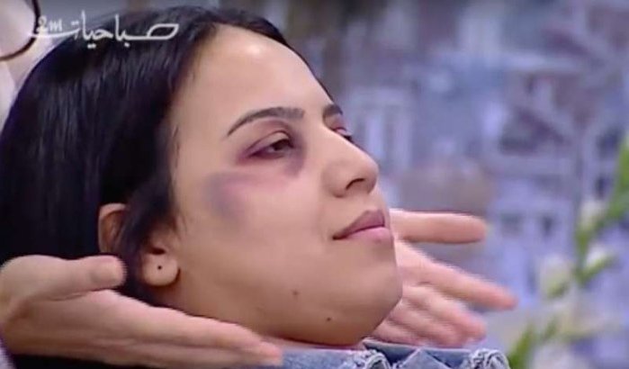 2M krijgt waarschuwing na make-up tips om huiselijk geweld te verhullen