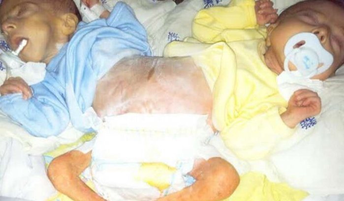 Ziekenhuis Rabat wil Siamese tweeling uitzetten
