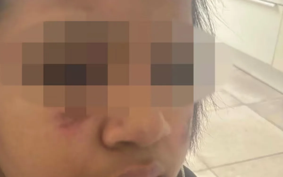 Camilia (14) mishandeld en in gezicht verbrand in Molenbeek