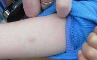 Marokko door tuberculose bedreigd