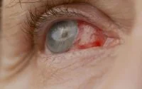 Rabat: patiënt blind na operatie door nepdokters