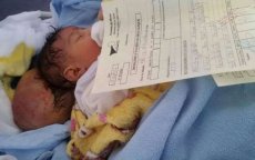 Marokko: baby met twee hoofdjes met succes geopereerd dankzij weldoener