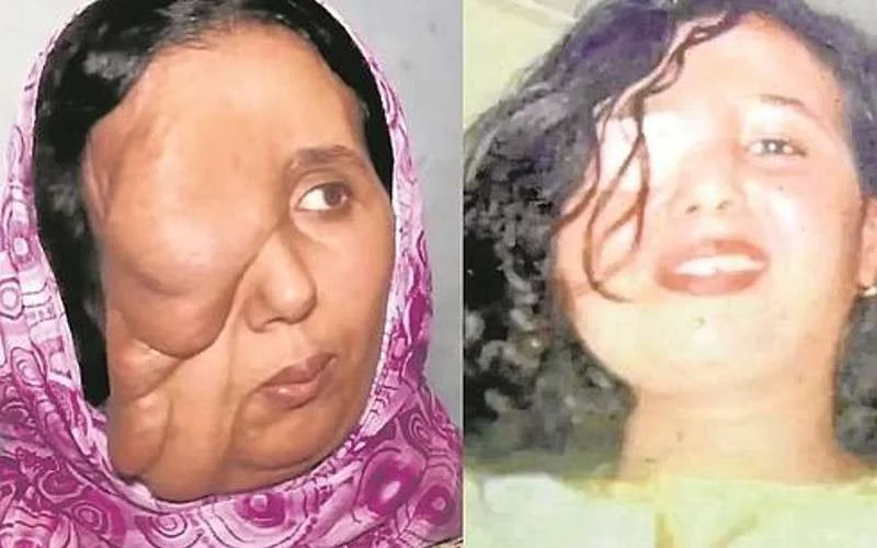 Marokkaanse krijgt nieuw gezicht dankzij bekende Spaanse chirurg