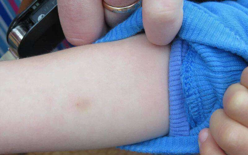 Marokko door tuberculose bedreigd