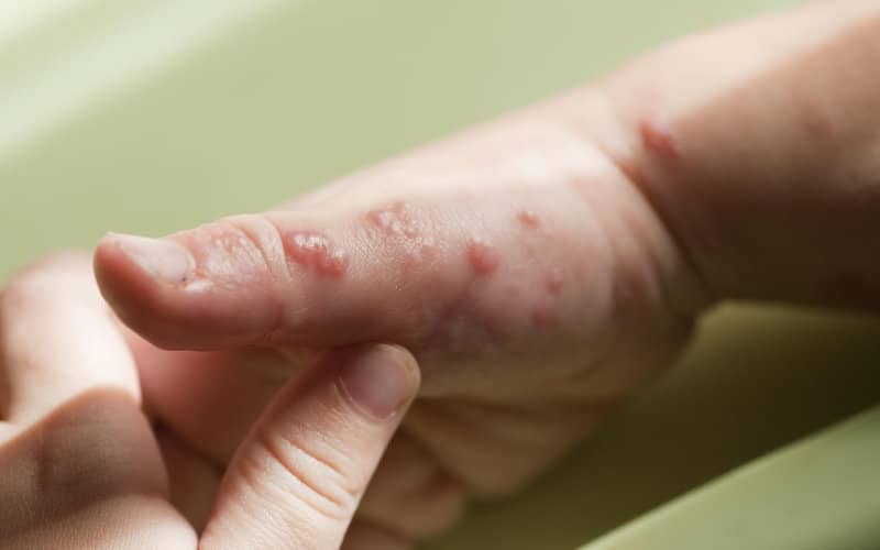 Marokko wil geneesmiddel tegen apenpokken kopen