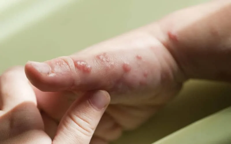 Marokko wil geneesmiddel tegen apenpokken kopen