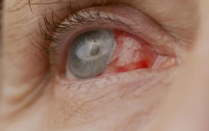 Rabat: patiënt blind na operatie door nepdokters