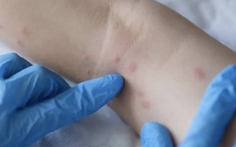 Marokko keurt protocol tegen apenpokken goed