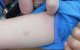 Marokko door tuberculose bedreigd